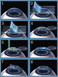 Fig. 1. Laser refraction correction (LASIK)